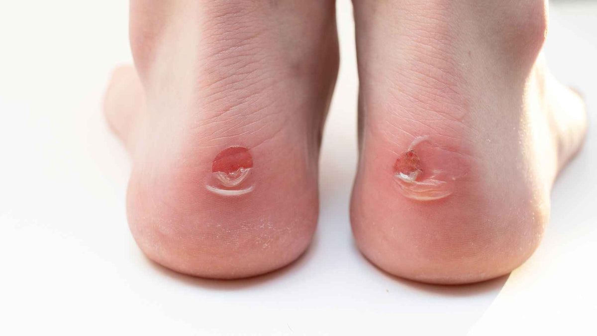 How to Prevent and Treat Blisters During Marathon Training